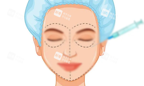 玻尿酸全脸填充展示