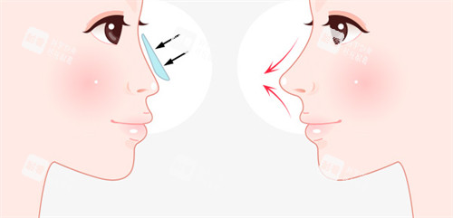 假体隆鼻前后对比