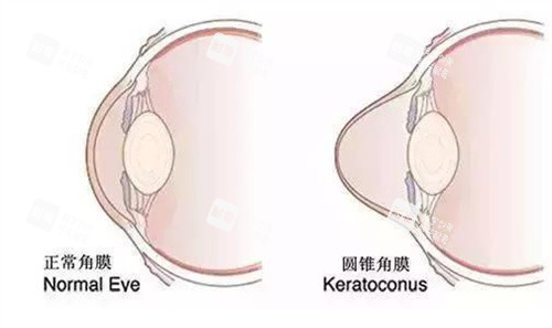 圆锥角膜示意图 圆锥角膜示意图