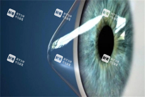 圆锥角膜 圆锥角膜