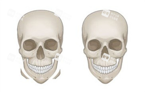 上官文松磨骨技术怎么样？技术流医生不仅截骨精细更看重骨肉紧致，2026口碑揭晓