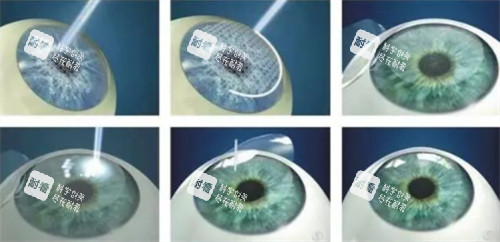 全飞秒近视手术过程详细图解