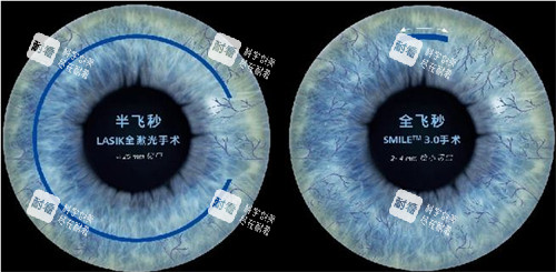 半飞和全飞创口区别