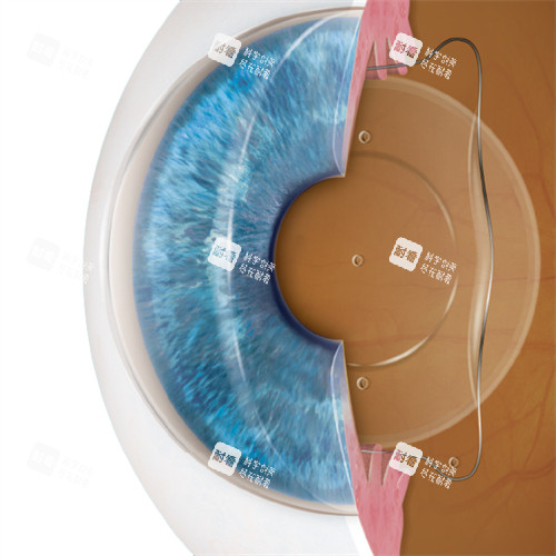 人工晶体植入眼睛示意图