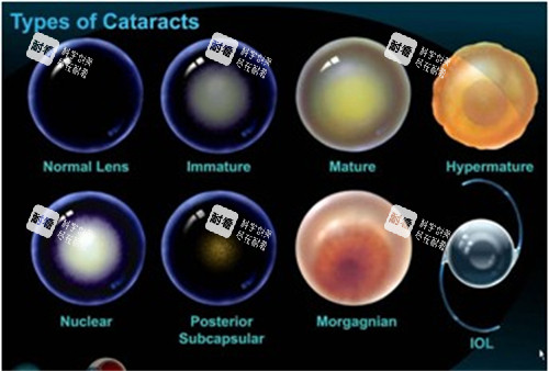 不同白内障晶体展示 不同白内障晶体展示