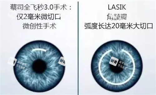 蔡司全飞秒3.0手术和LASIK对比