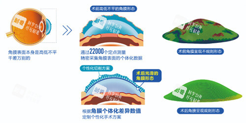 近视眼手术前后角膜变化示意图