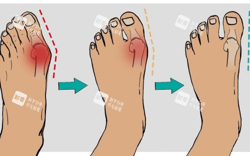 拇指外翻矫正示意图