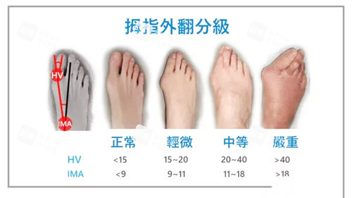 拇指外翻图