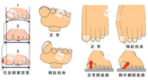 拇指外翻示意图