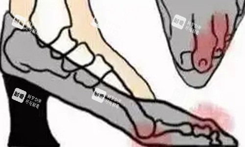 拇指外翻产生的影响