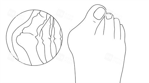 拇指外翻的样子