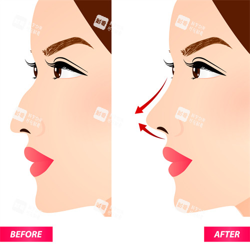 隆鼻手术改善鼻子角度