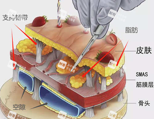 SMAS筋膜层