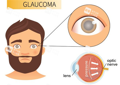 青光眼的表现 青光眼的表现