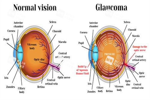正常与青光眼对比 正常与青光眼对比