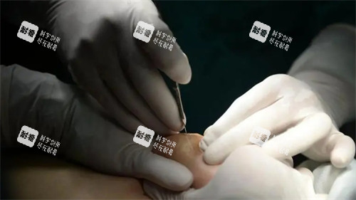 不明注射物取出手术中