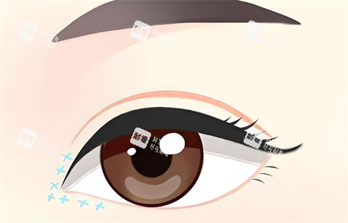 开眼角动画展示图片