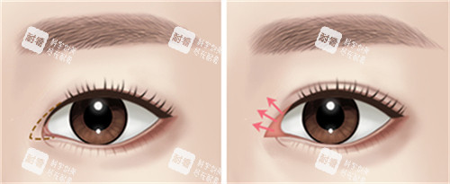 开内眼角的位置图解