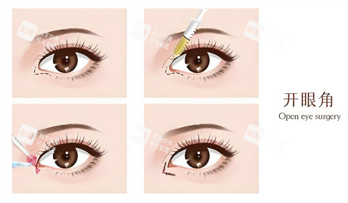 开内眼角演示动画图