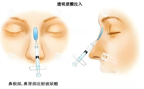 隆鼻玻尿酸注射图