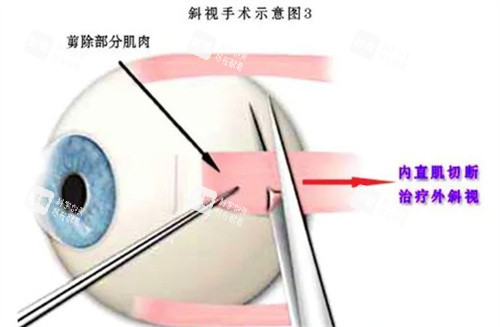 斜视手术示意图