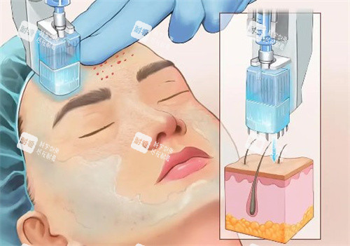 激光去红血丝过程图