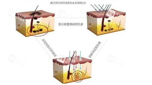 激光去痣原理