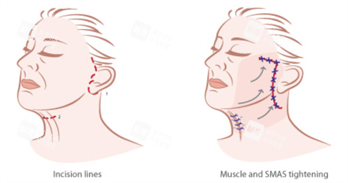 面部提升手术的对比和切口
