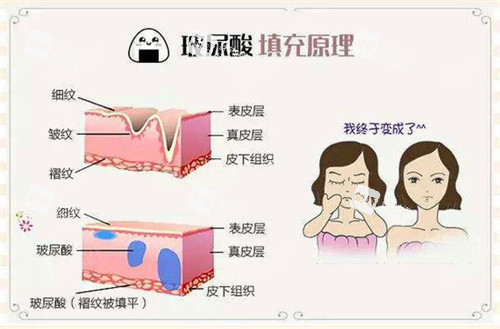 玻尿酸注射填充原理动画演示图