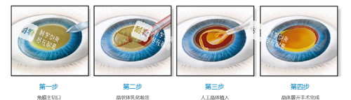 单焦晶体和多焦晶体8