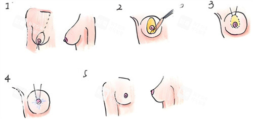 乳房下垂矫正术过程