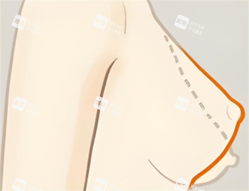 乳房下垂矫正轮廓对比