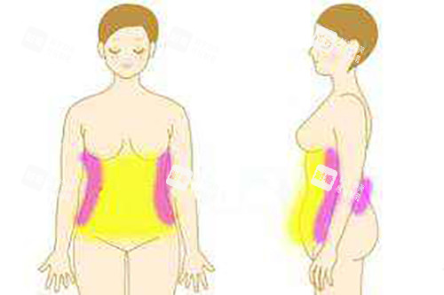 腰腹吸脂卡通示意图 