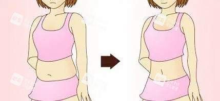 腰腹吸脂对比卡通图