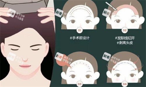 额头缩小手术过程