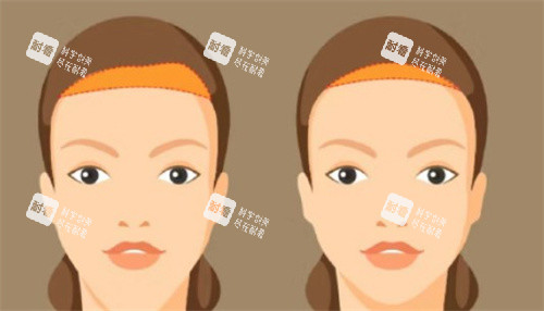 额头缩小手术对比