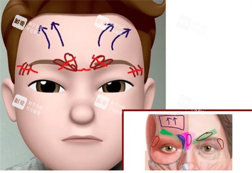 内窥镜提升额头