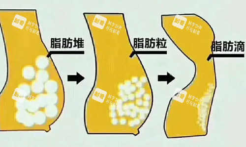 脂肪型胸部脂肪展示