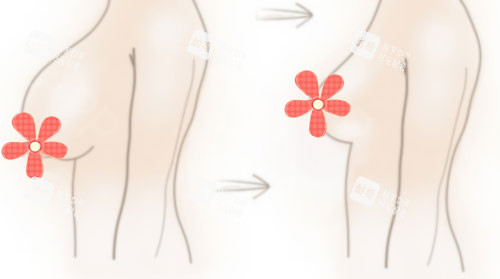 丰胸乳房缩小手术对比漫画图