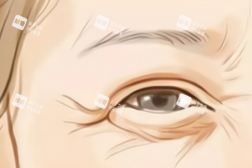 鱼尾纹卡通展示图