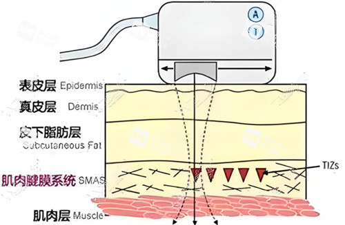 热拉提作用皮肤层
