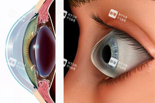 近视眼球外突示意图