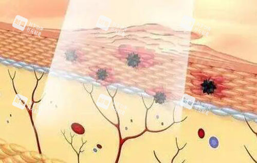 激光美肤作用展示