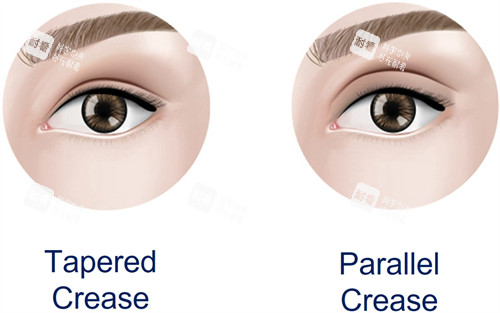 双眼皮加宽手术前后对比图