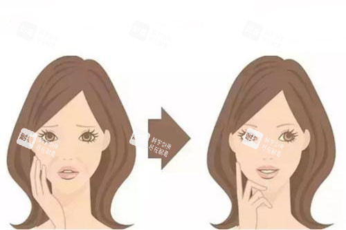 面部注射卡通对比图