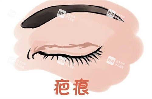 双眼皮术后疤痕