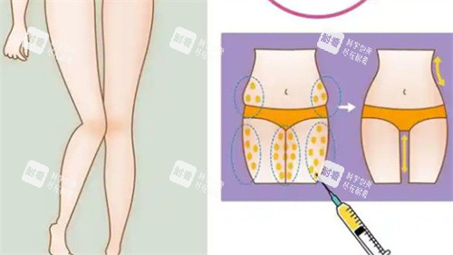 大腿吸脂手术