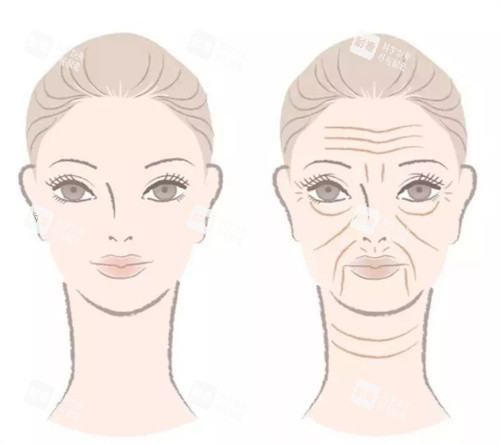 除皱抗衰前后对比、