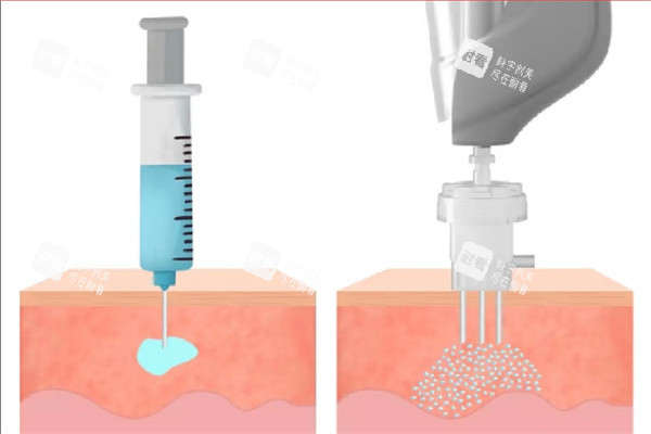 水光针注射方式